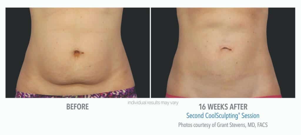 coolsculpting-before-and-after-1 coolsculpting-before-and-after-1