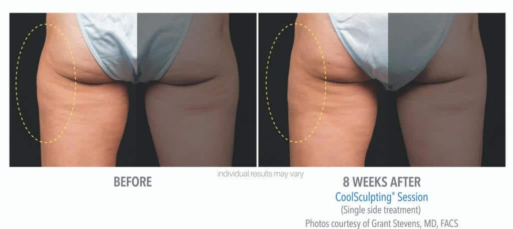 coolsculpting-before-and-after-2 coolsculpting-before-and-after-2