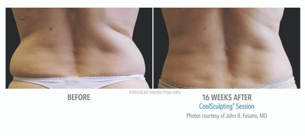 coolsculpting-before-and-after-3 coolsculpting-before-and-after-3