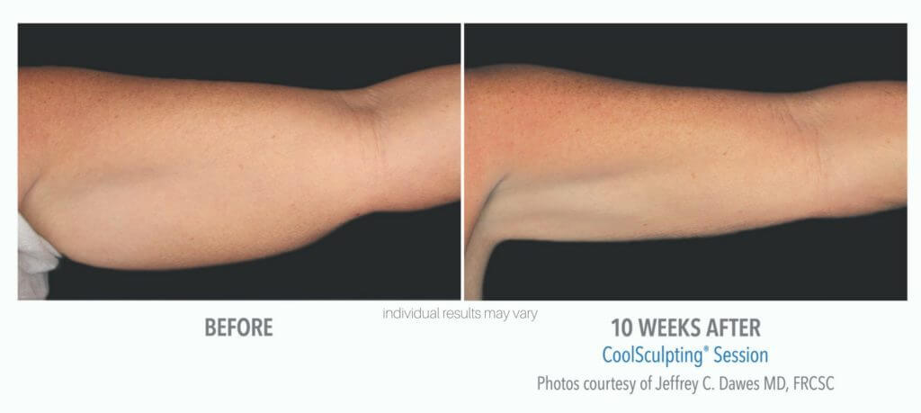 coolsculpting-before-and-after-4 coolsculpting-before-and-after-4