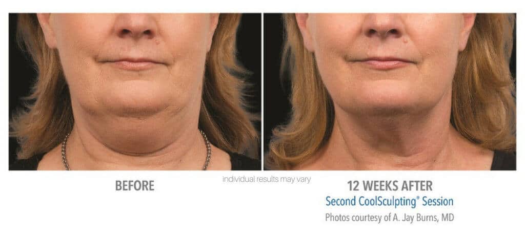 coolsculpting-before-and-after-5 coolsculpting-before-and-after-5