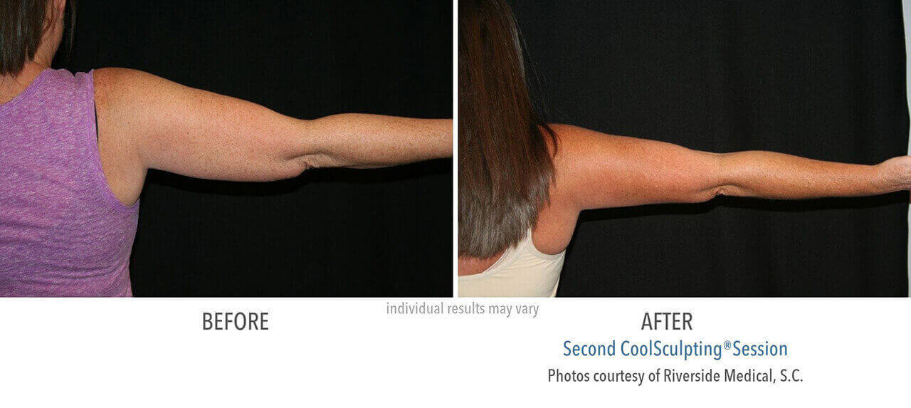 coolsculpting-before-and-after-riverside-medical-chicago-2