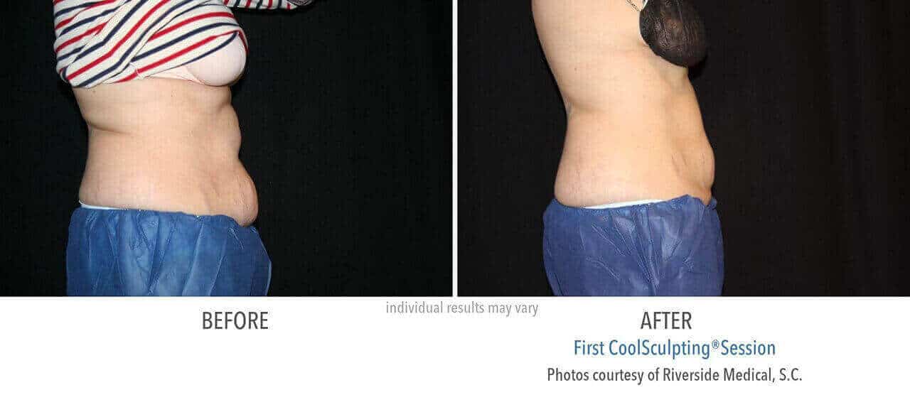 coolsculpting-before-and-after-riverside-medical-chicago-4