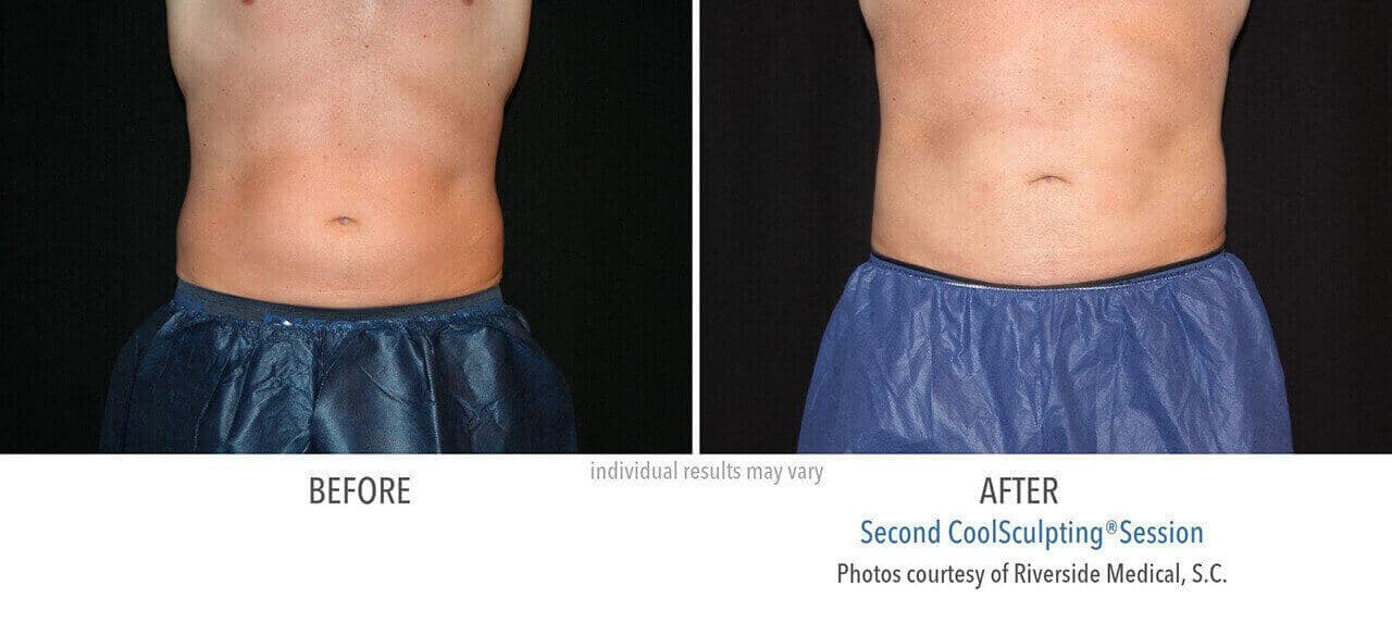 coolsculpting-before-and-after-riverside-medical-chicago-5