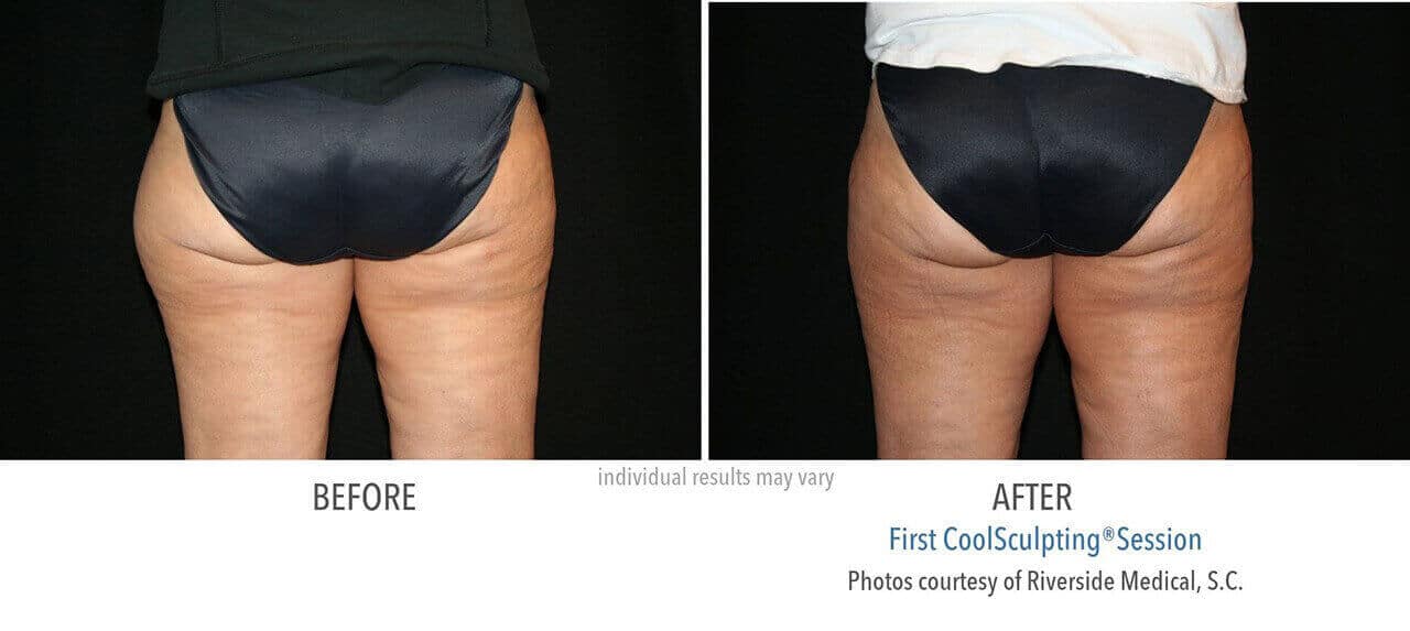 coolsculpting-before-and-after-riverside-medical-chicago-8