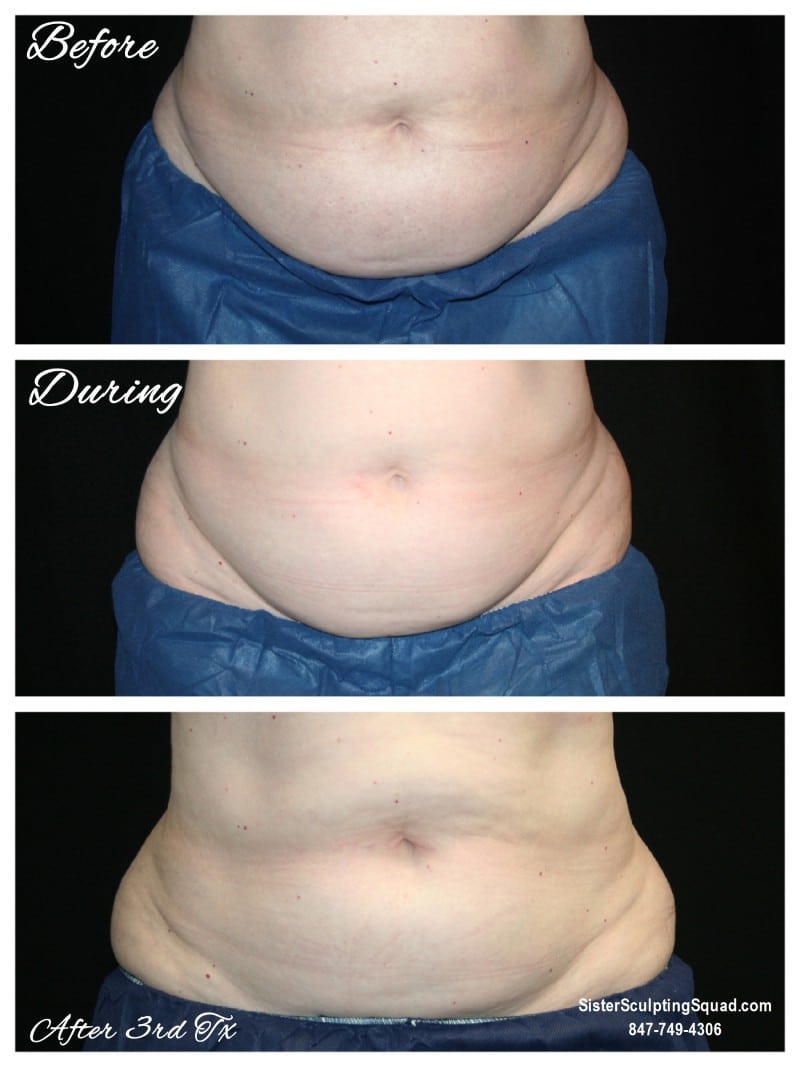 CoolSculpting Before and After Picture of Female Lower Abdomen