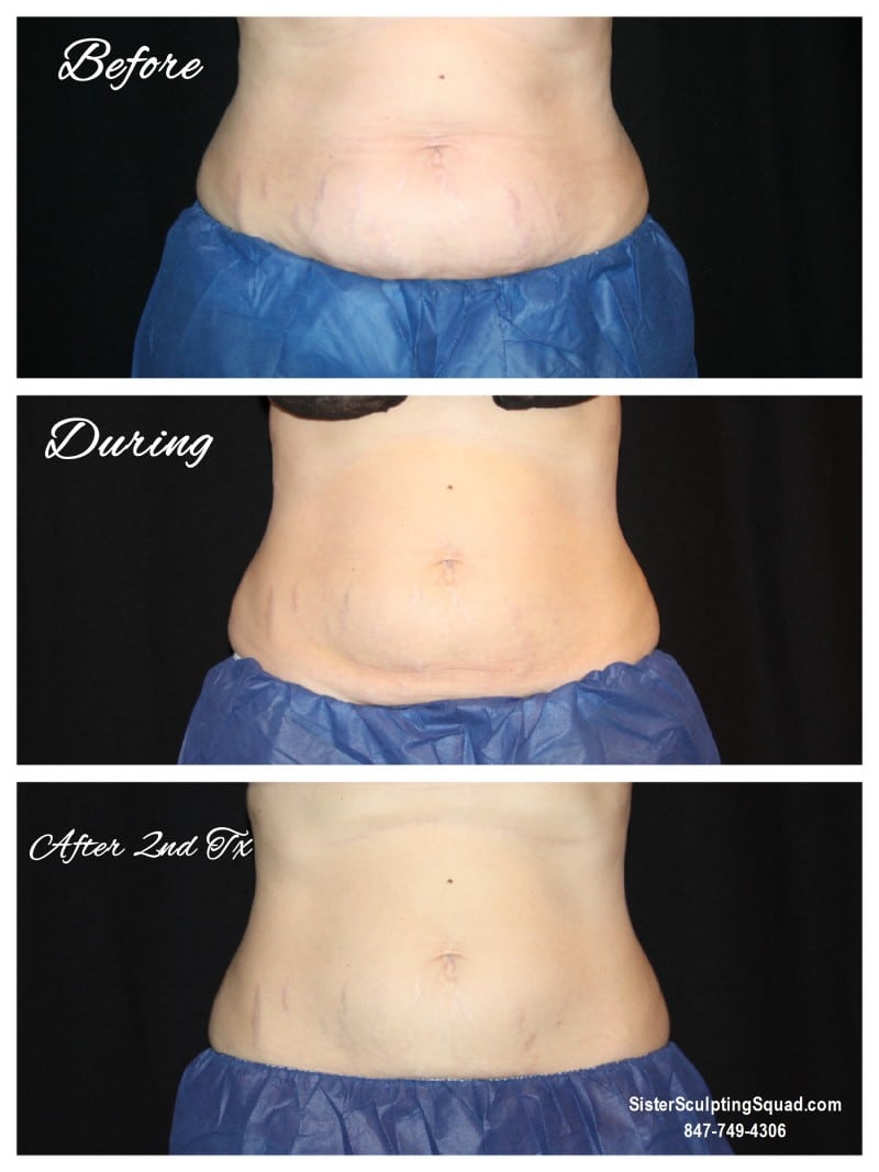 CoolSculpting Before and After - Abs