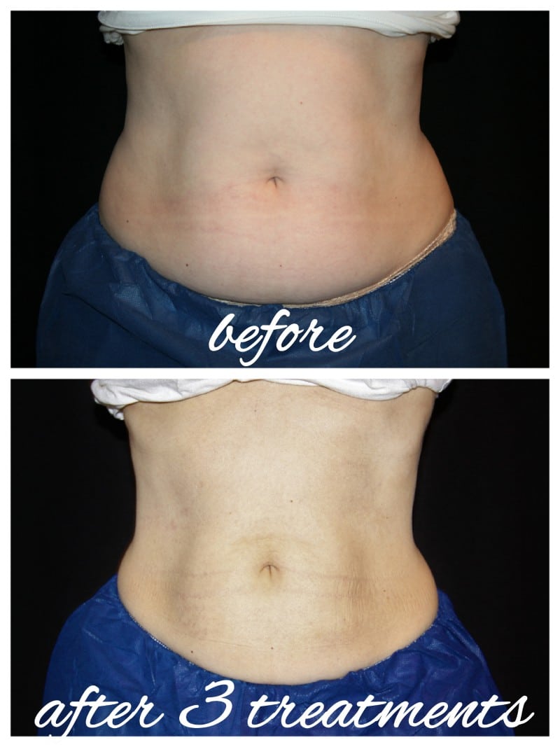 CoolSculpting Before and After - Abs