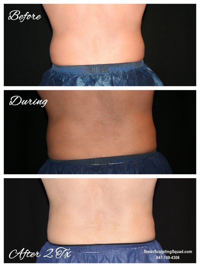 CoolSculpting Before and After - Love Handles
