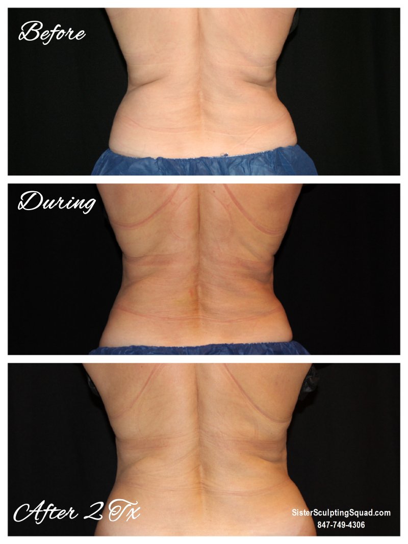 CoolSculpting Love Handles, Coolsculpting flanks before and after photos,  liposuction love handles