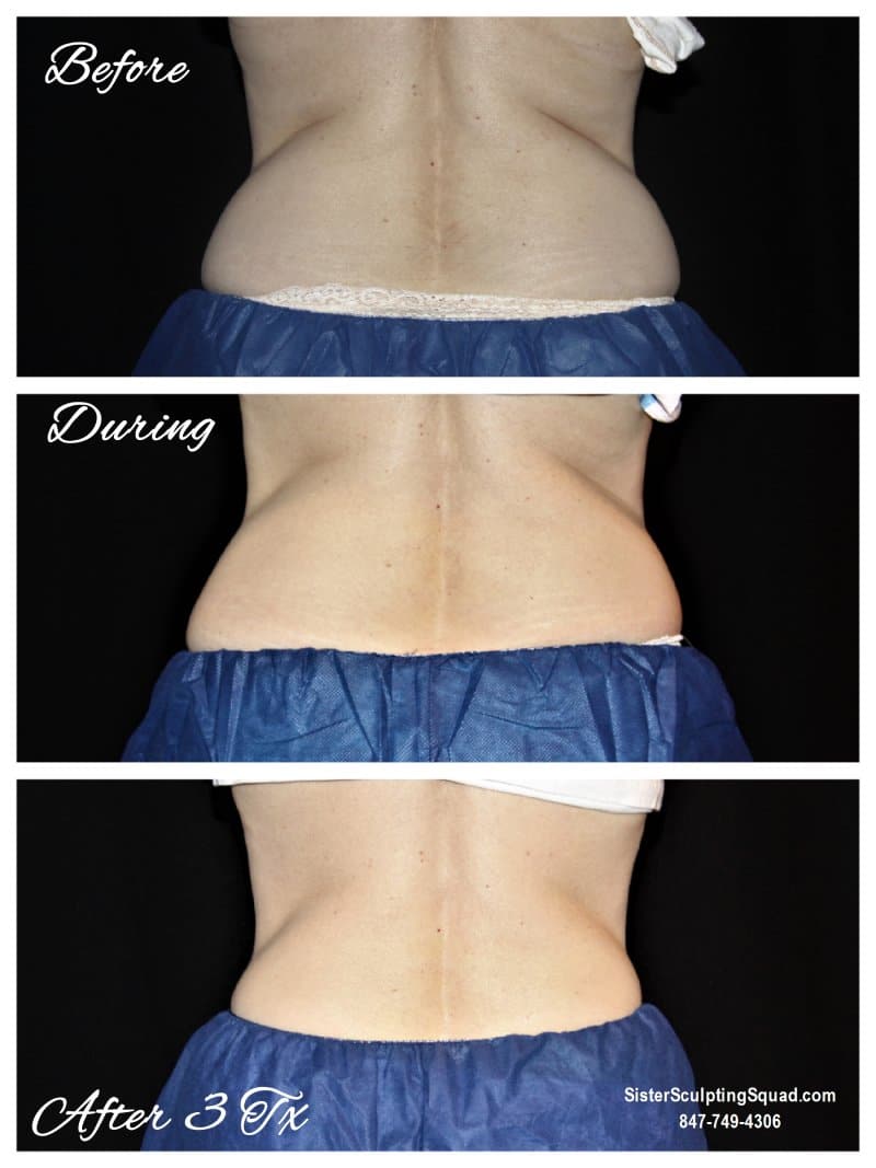 CoolSculpting® Flanks – Love Handles Photo Gallery