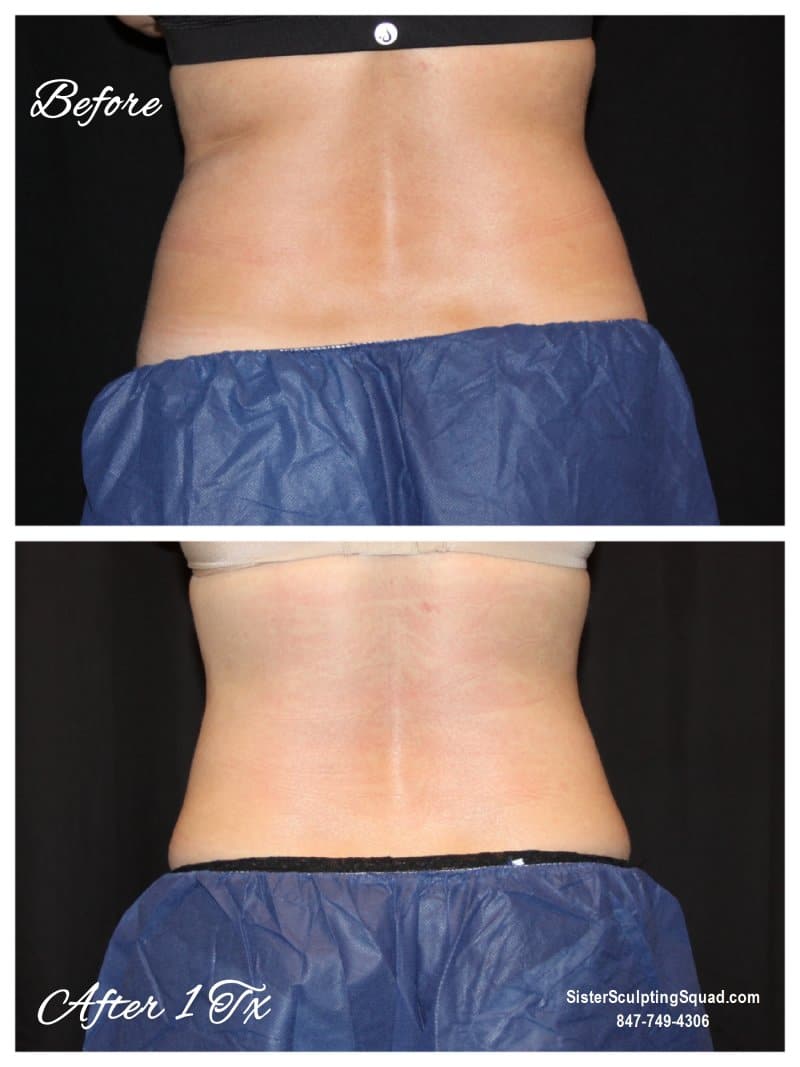 CoolSculpting Before and After - Love Handles