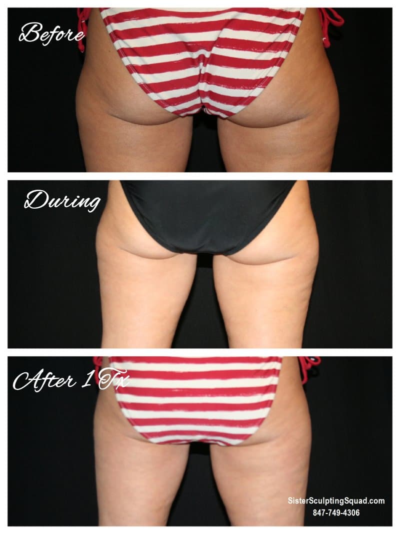 CoolSculpting Before and After - Outer Thighs