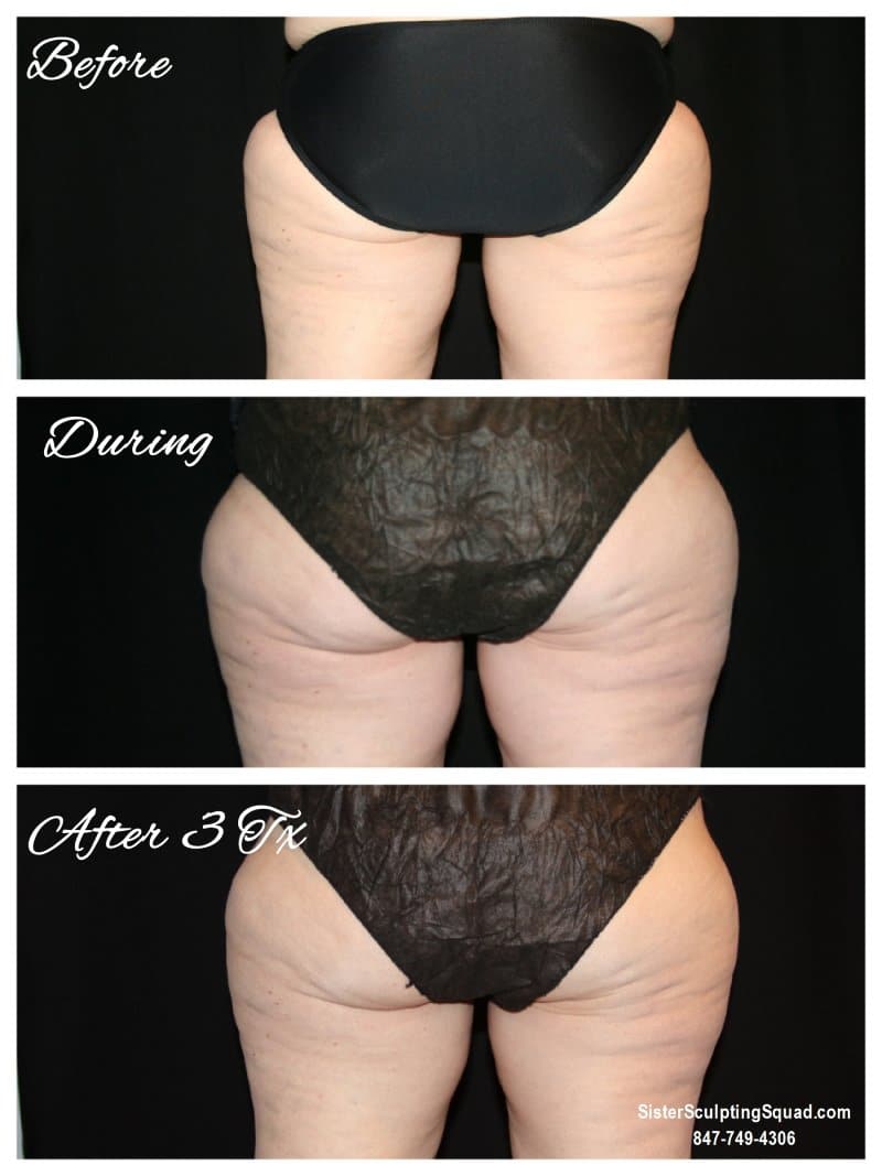 CoolSculpting Before and After - Outer Thighs