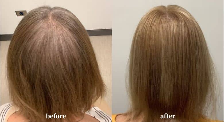 alma-ted-hair-restoration-riverside-medical-chicago-il-before-and-after-images-1