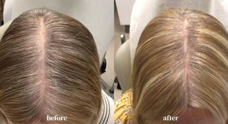 alma-ted-hair-restoration-riverside-medical-chicago-il-before-and-after-images-2