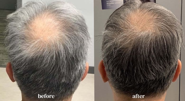 alma-ted-hair-restoration-riverside-medical-chicago-il-before-and-after-images-3