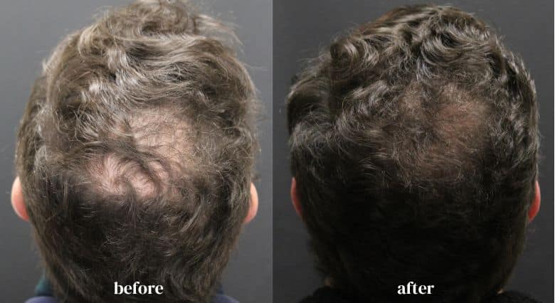 alma-ted-hair-restoration-riverside-medical-chicago-il-before-and-after-images-4